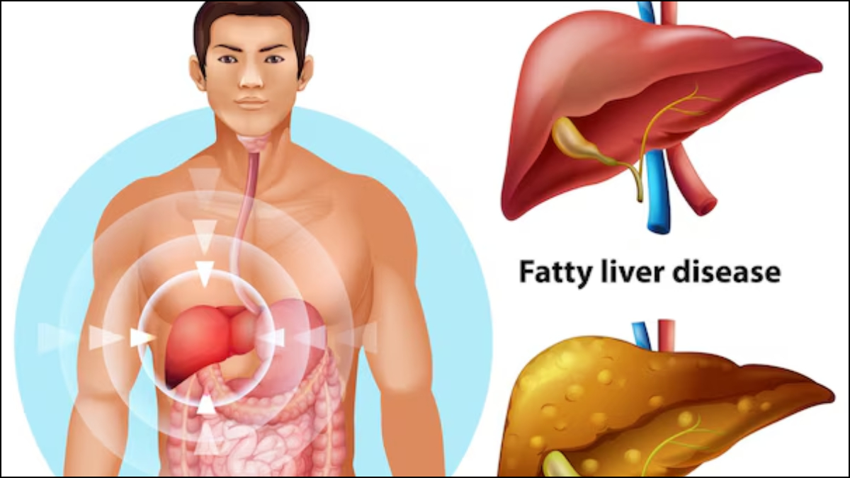 Read more about the article हर तीसरे भारतीय को है फैटी लिवर की समस्या: जानें लक्षण, कारण और लिवर को हेल्दी रखने के टिप्स
