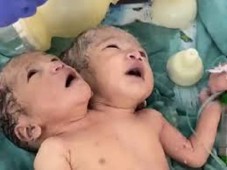 Read more about the article MP में चौंकाने वाला मामला: इंदौर में फिर जन्मी दुर्लभ नवजात, एक शरीर में दो सिर, दो दिल और चार हाथ; डॉक्टर भी हैरान, PICU में चल रहा इलाज!